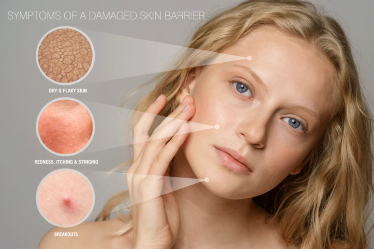 How to Repair a Damaged Skin Barrier